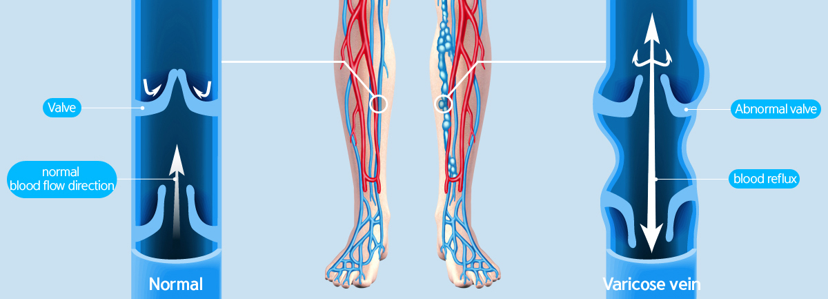 하지정맥류 이미지