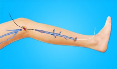 시술과정 이미지