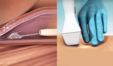 시술과정 이미지