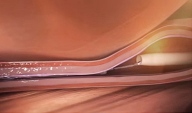 시술과정 이미지