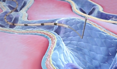 시술과정 이미지