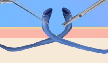 시술과정 이미지