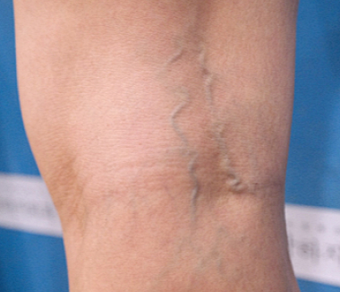 망상정맥류이미지