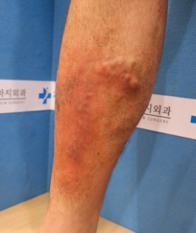 Venous Dermatitis
