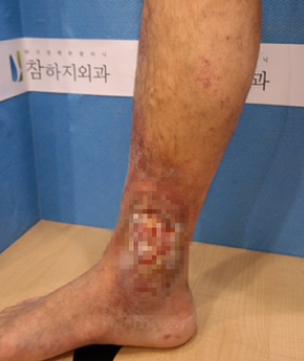 Venous Ulcer